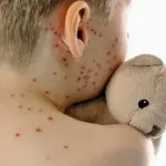 Il morbillo: un problema di salute che uccide ancora